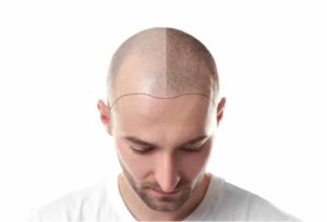 dermopigmentation cuir chevelu au pradet
